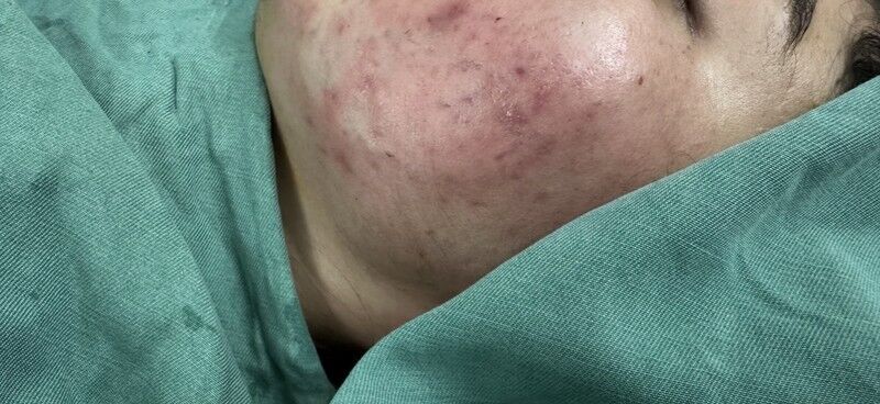 Acne Scar Treatment After