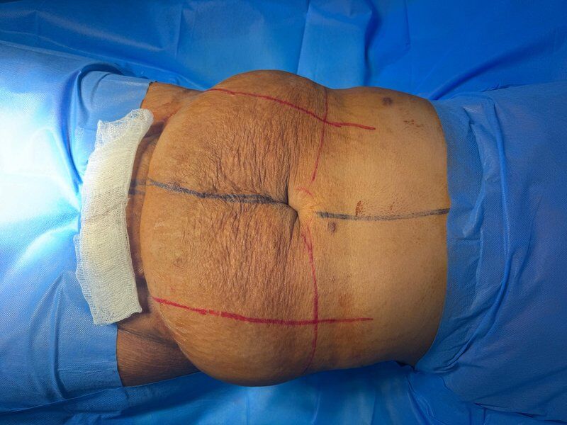 Aesthetic Gynecology Before