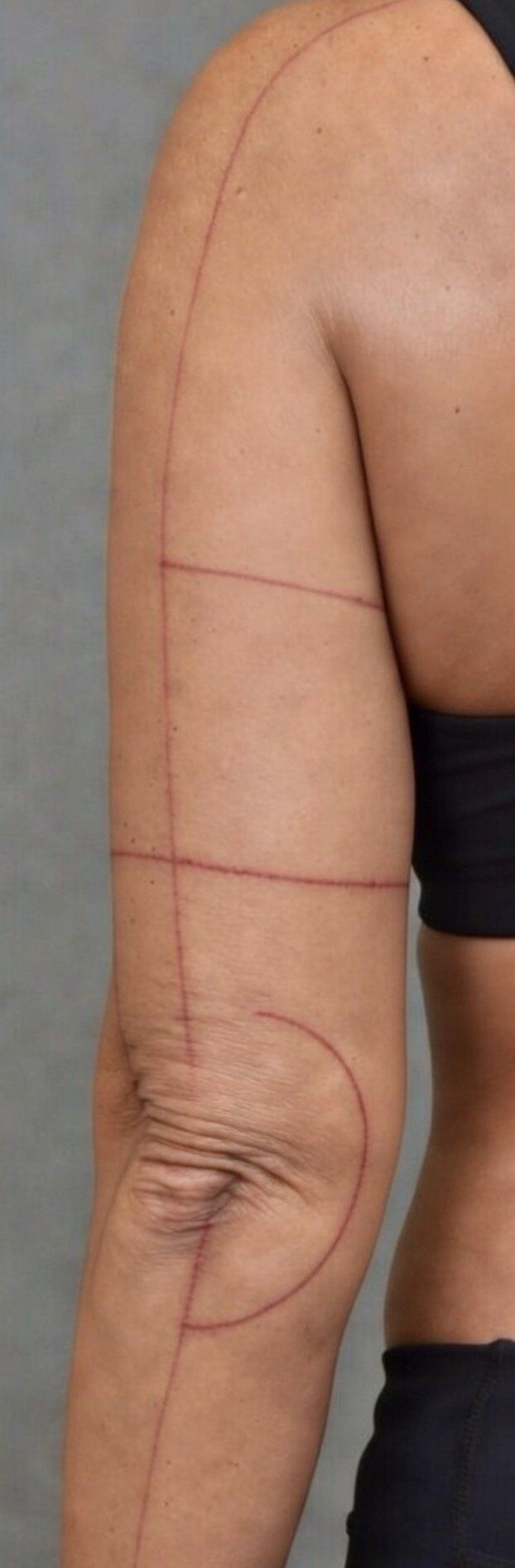 Arm Lift (Brachioplasty) After