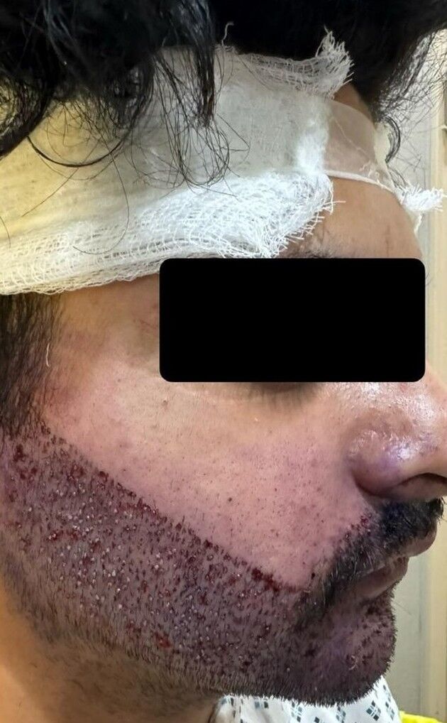 Beard Transplant After