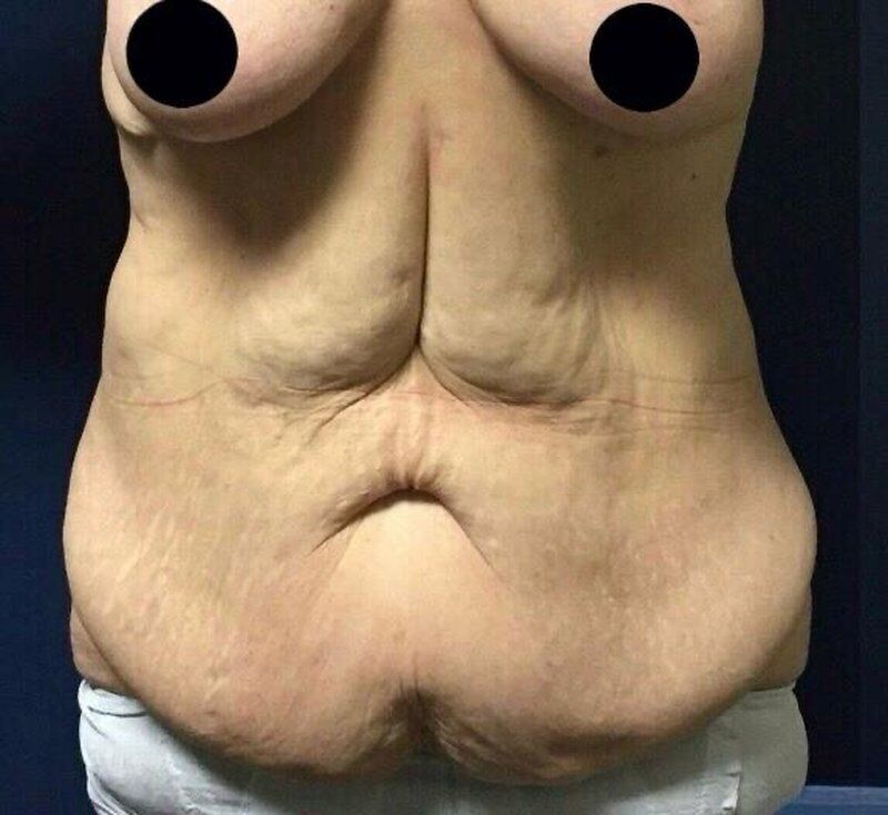 Body Contouring After Weight Loss Before