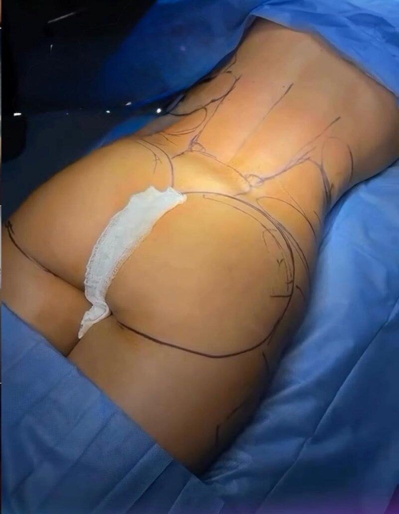 Brazilian Butt Lift (BBL) Before