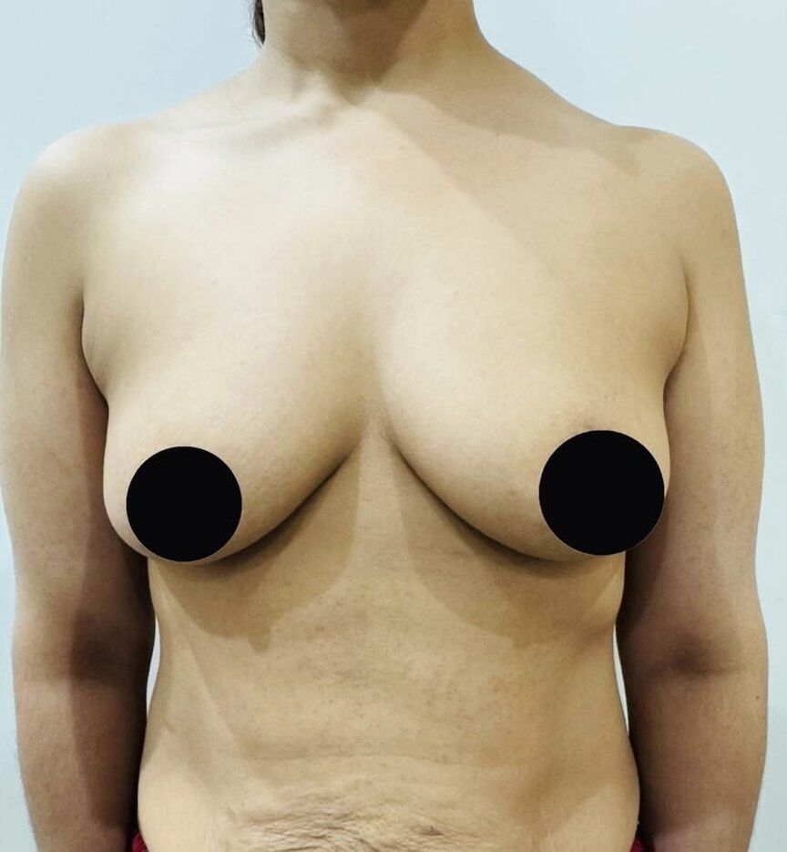 Breast Augmentation Before