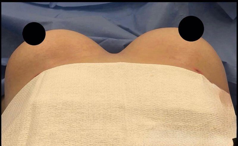 Breast Augmentation with Fat Transfer After