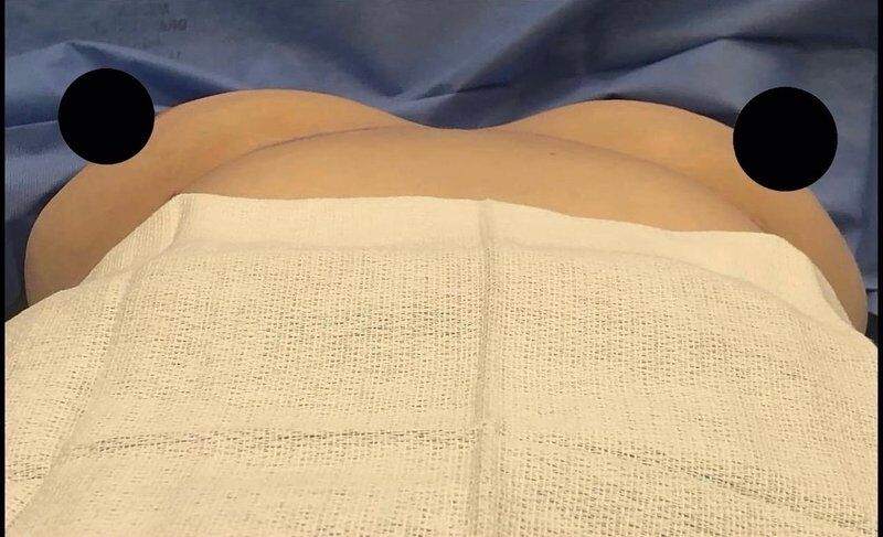 Breast Augmentation with Fat Transfer Before