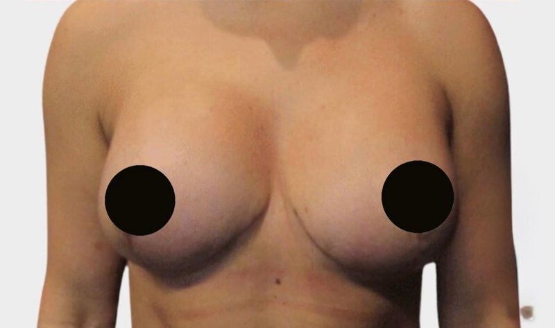 Breast Lift (Mastopexy) After