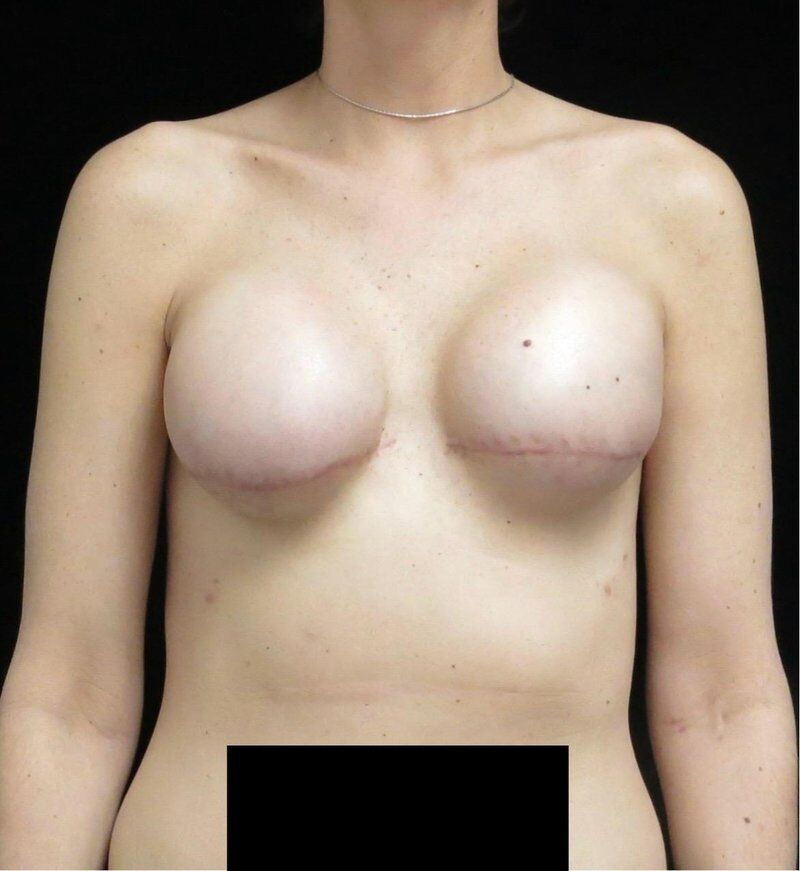 Breast Reconstruction After