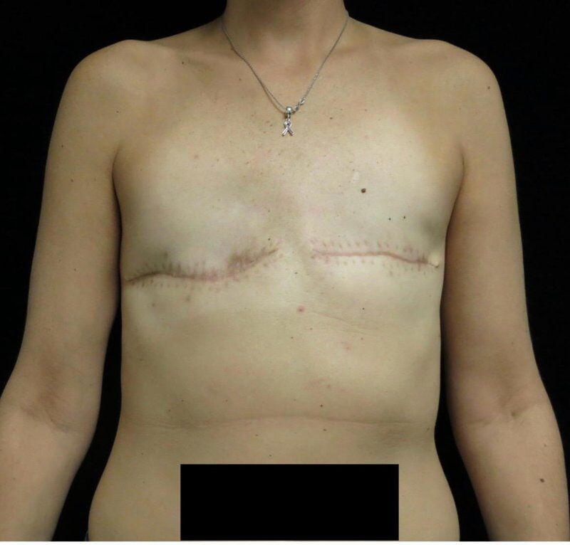 Breast Reconstruction Before
