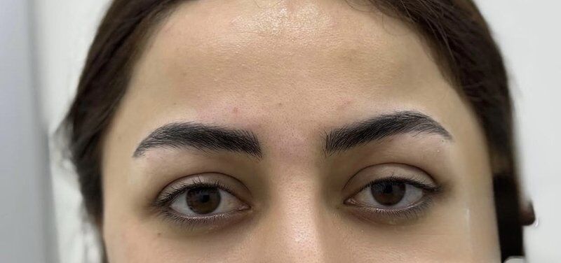Brow & Forehead Lift After