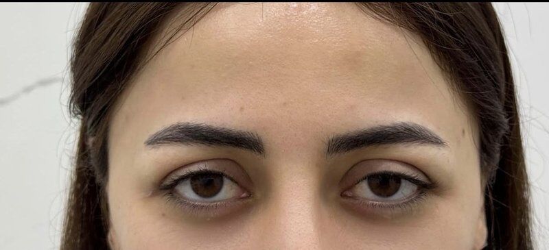 Brow & Forehead Lift Before