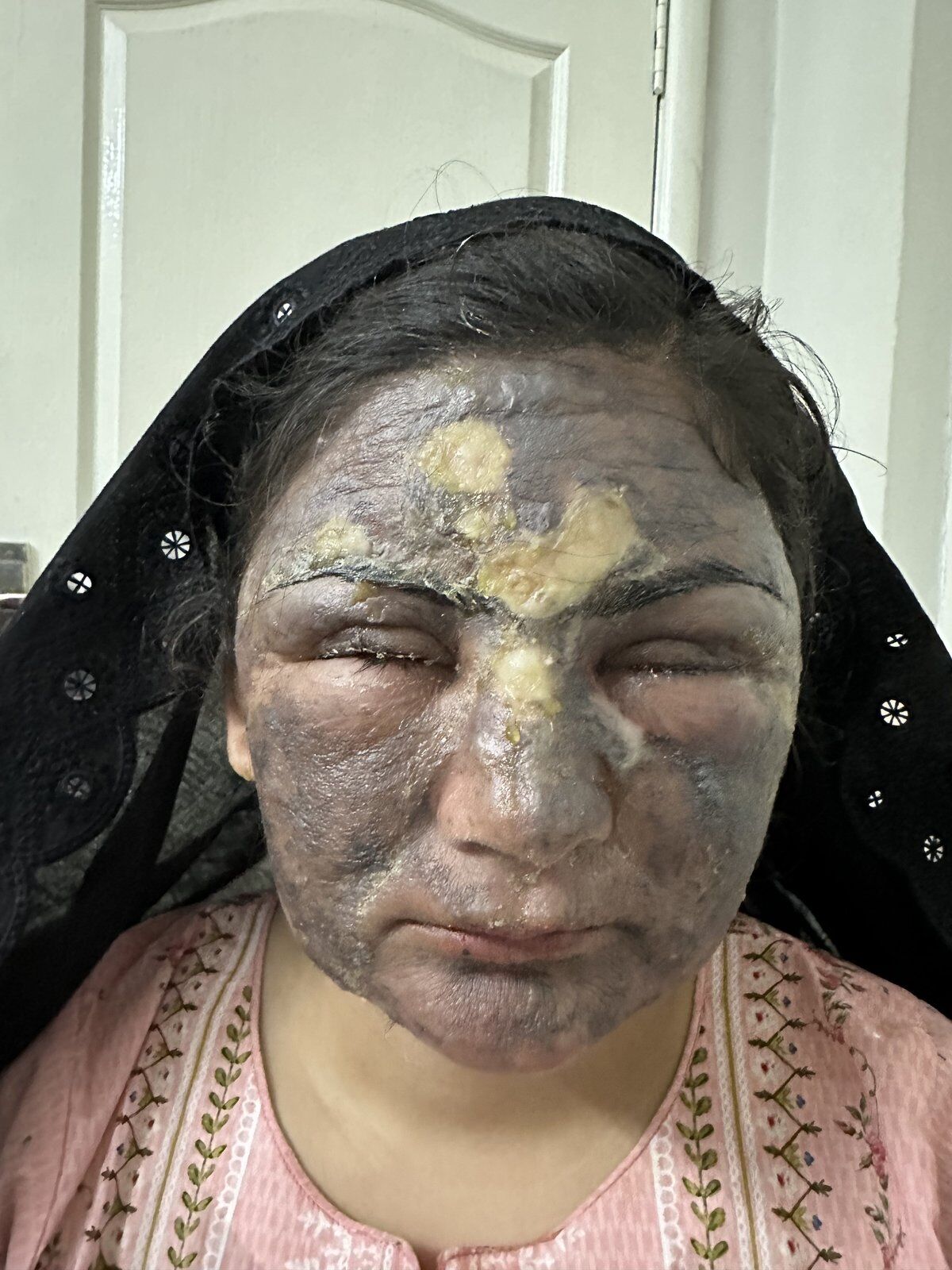 Burn Reconstruction Before