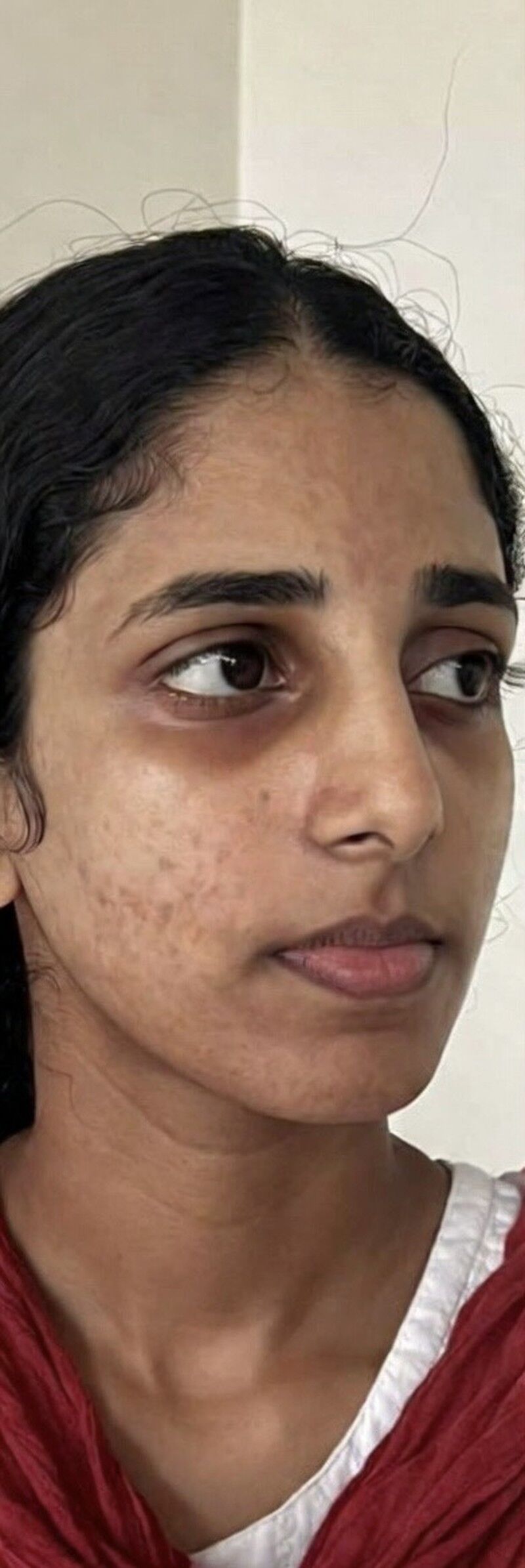 Chemical Peels Before