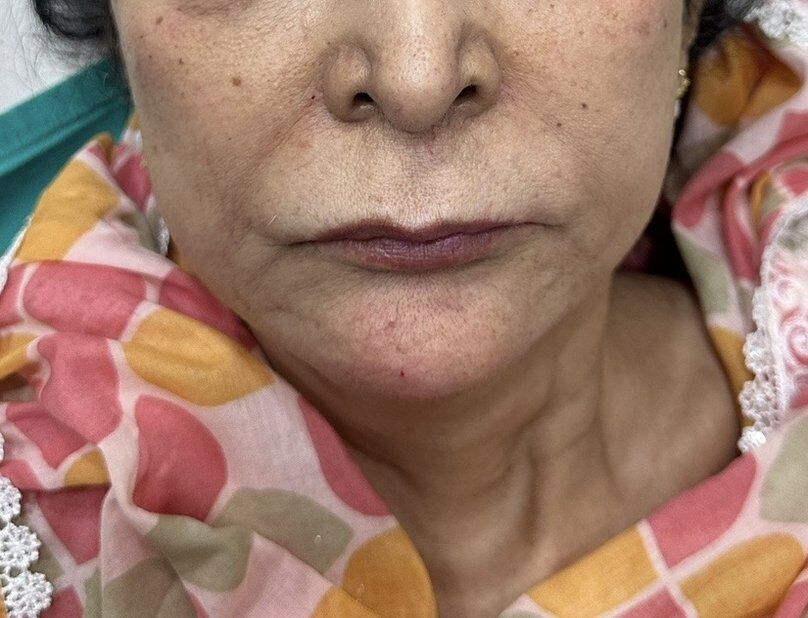 Chin Reshaping (Mentoplasty) After