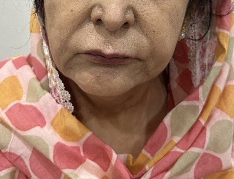 Chin Reshaping (Mentoplasty) Before