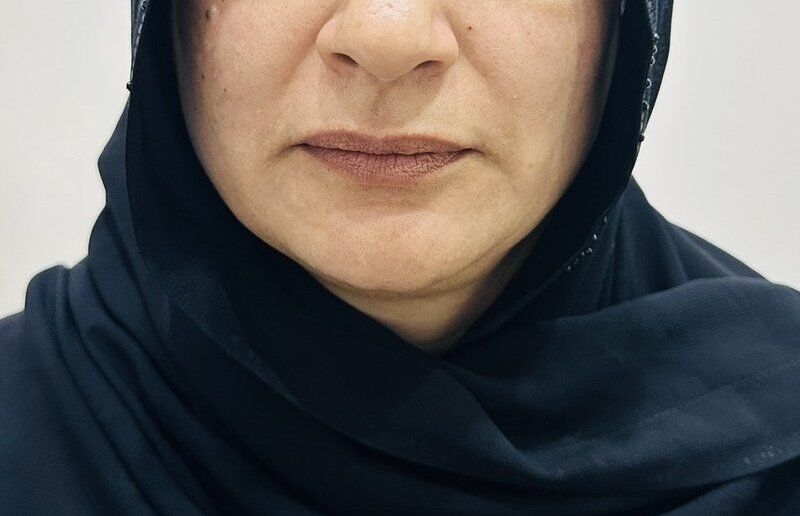 Dermal Fillers Before