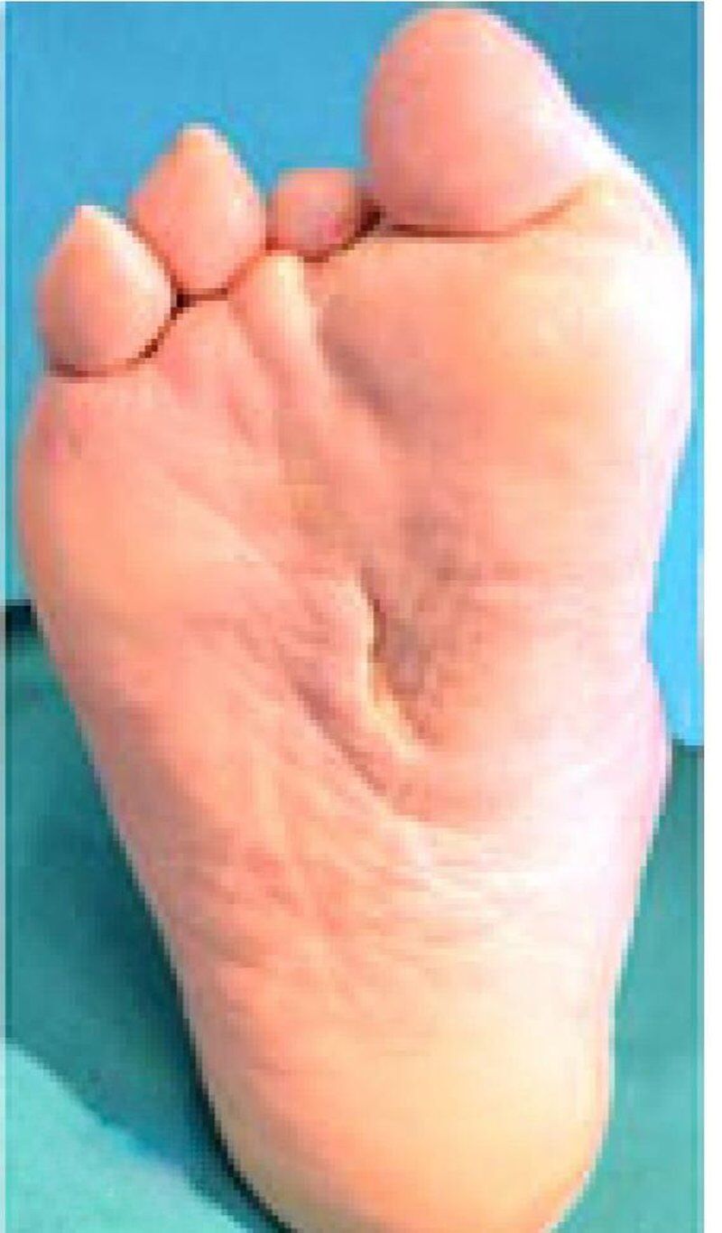 Diabetic Foot Management After