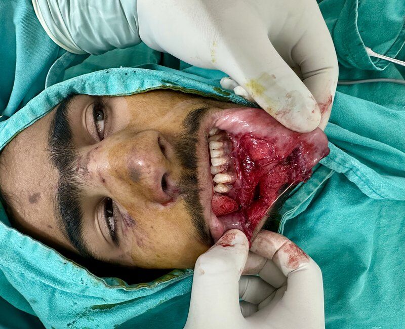 Face Trauma Reconstruction Before