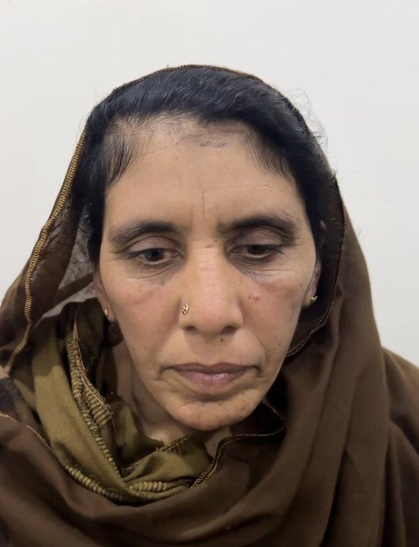 Facelift (Rhytidectomy) After