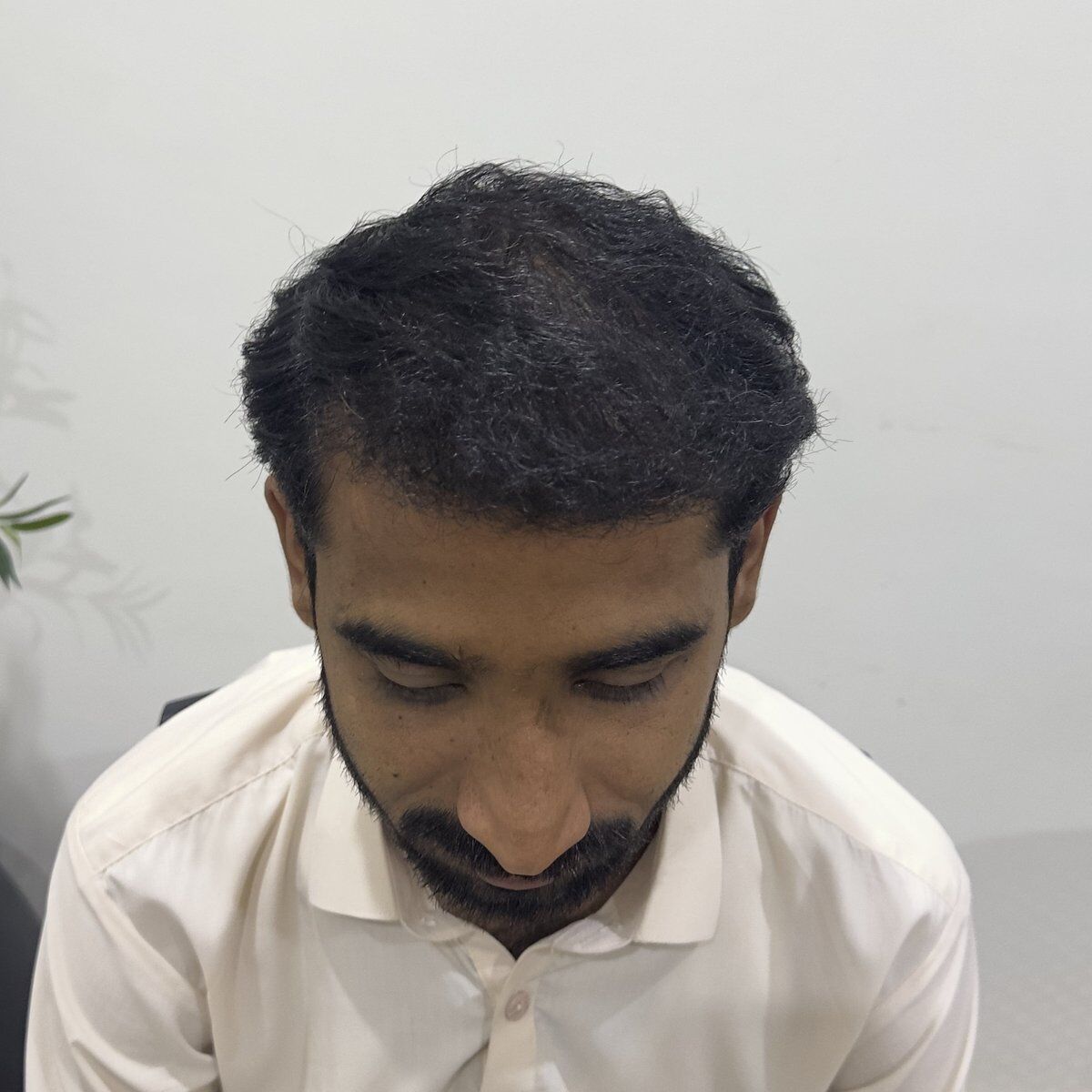 Hair Transplant After