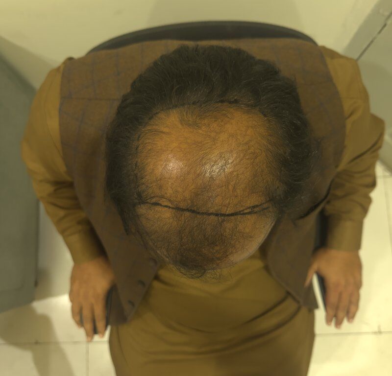 FUT Hair Transplant Before