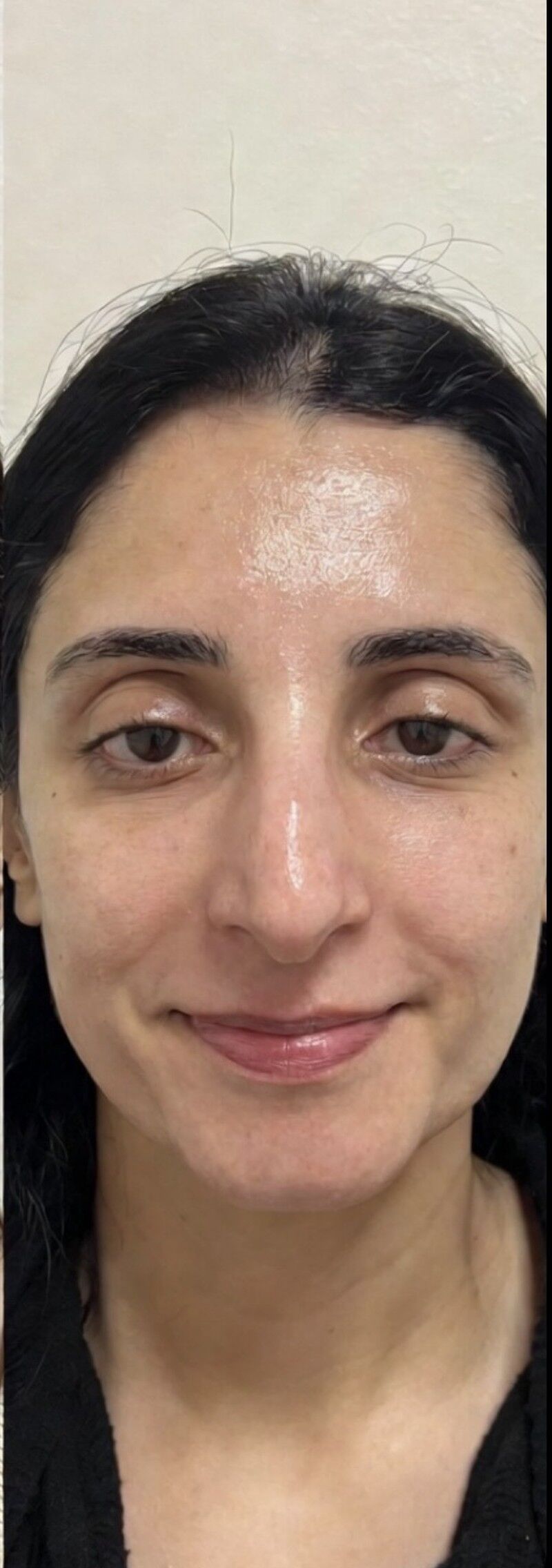 HydraFacial After
