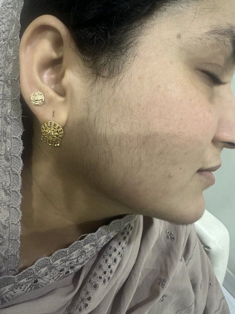 Laser Hair Removal Before