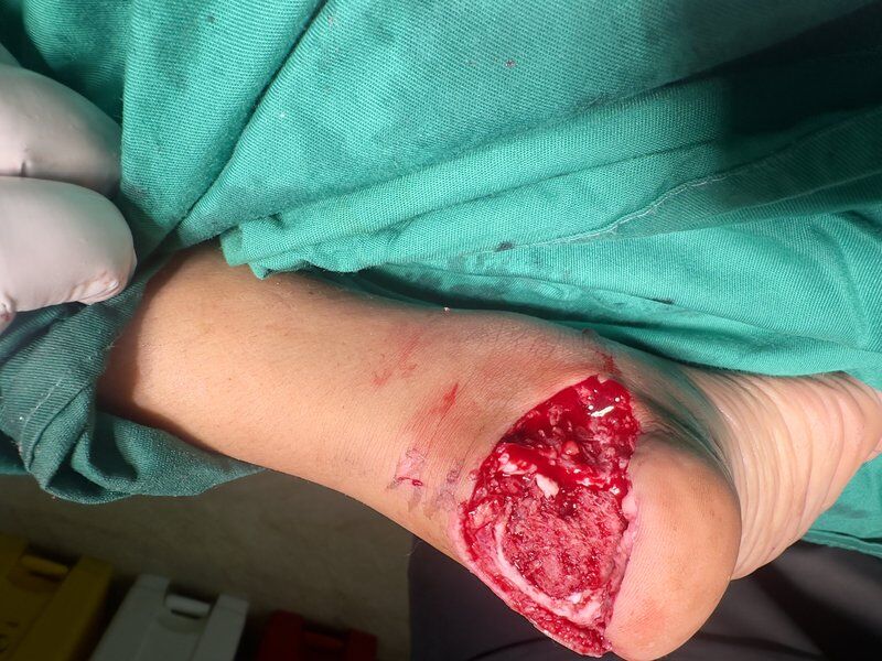 Limb Reconstruction Before