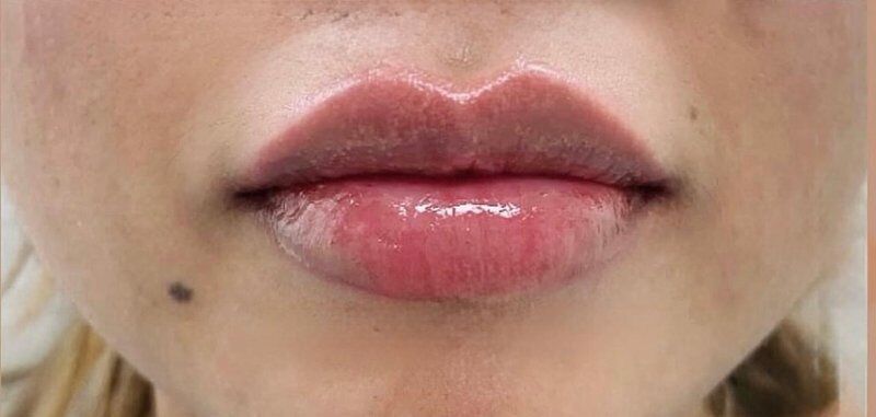 Lip Lift After