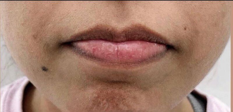 Lip Lift Before