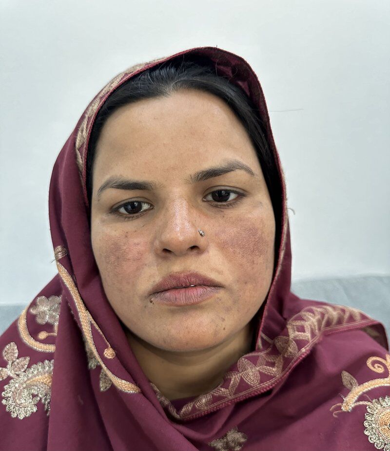 Microneedling Before