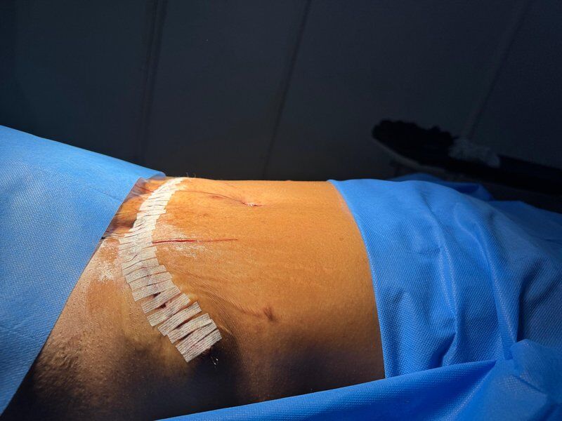 Mommy Makeover After