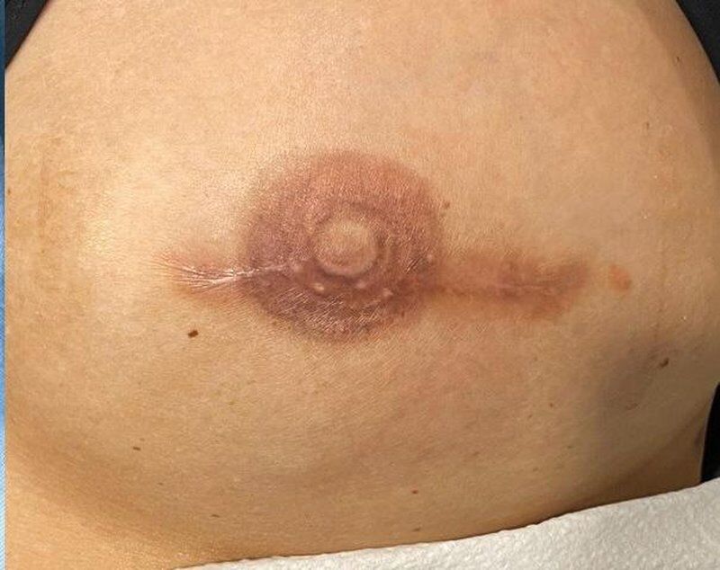 Nipple/Areola Correction After