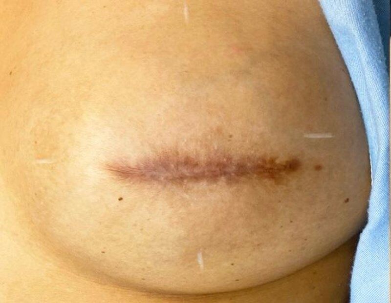 Nipple/Areola Correction Before