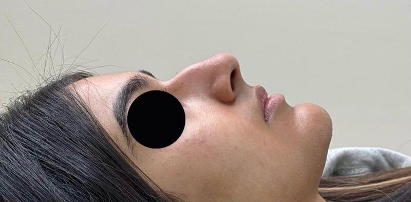 Non-Surgical Rhinoplasty Before