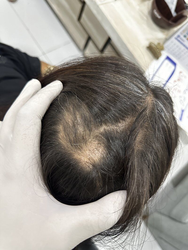 PRP Hair Therapy Before