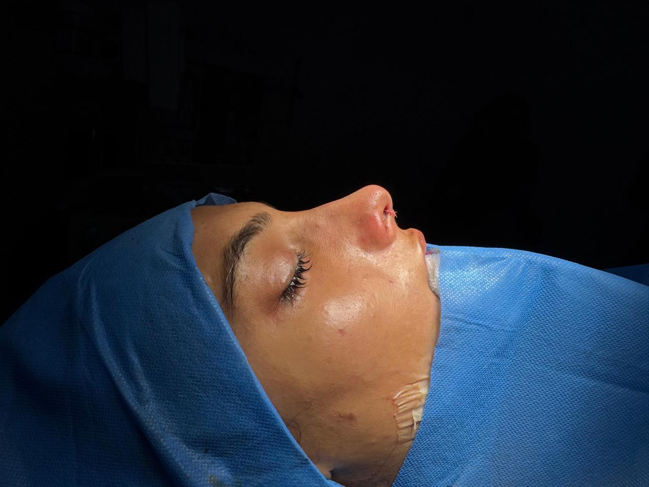 Rhinoplasty After