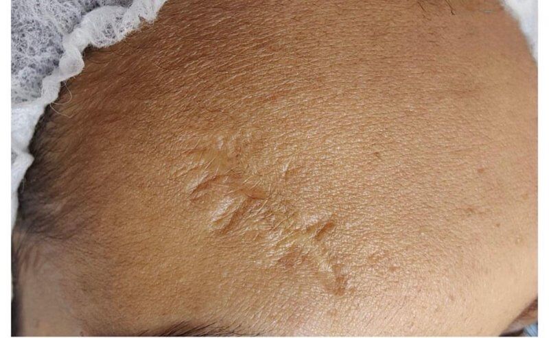 Scar Revision Before