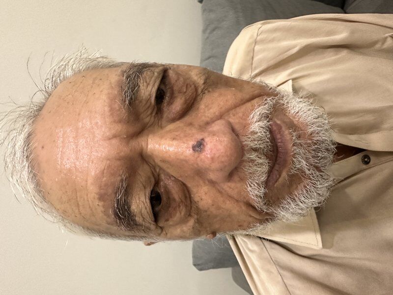 Skin Cancer Surgery Before