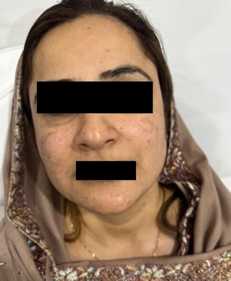 Skin Whitening & Brightening Before