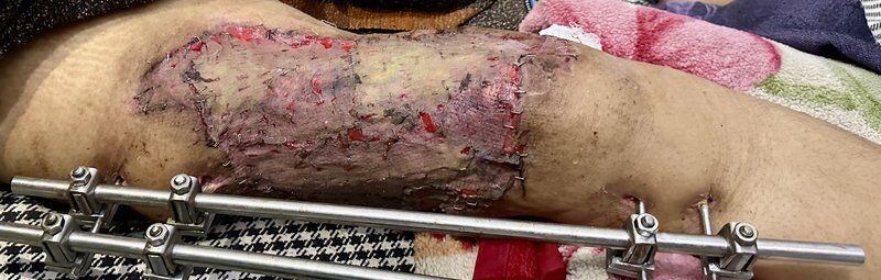 Wound Management After