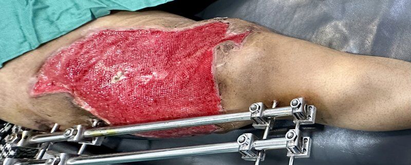 Wound Management Before